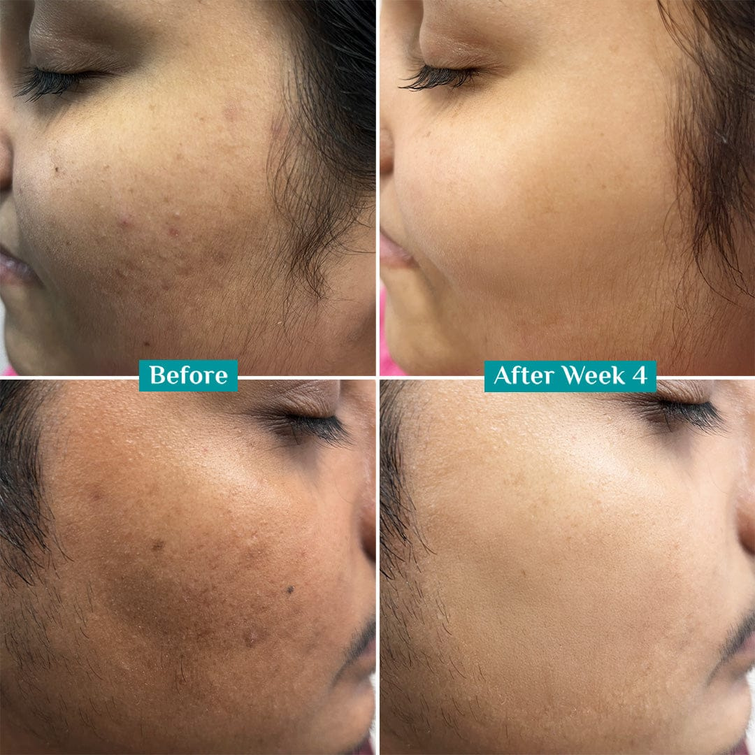 Teashell Niacinamide Brightening Serum Fades Dark Spots, Evens Skin Tone & Boosts Glow (Copy)